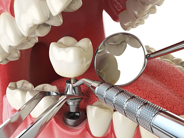 Best Emergency Wisdom Teeth Removal in Gordon, GA